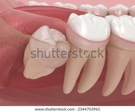 Abnormal position of wisdom teeth. Medically accurate tooth 3D illustration