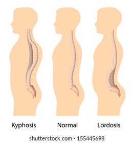 Image result for lordosis