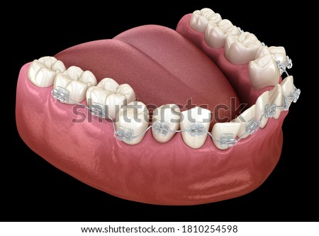 Abnormal teeth position and clear braces tretament. Medically accurate dental 3D illustration