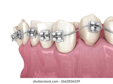 Abnormal teeth position and correction with metal braces tretament. Medically accurate dental 3D illustration