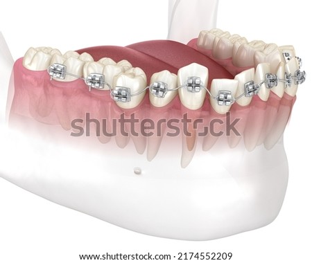 Abnormal teeth position and correction with metal braces tretament. Medically accurate dental 3D illustration