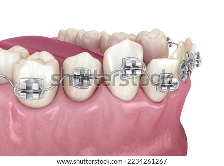 Abnormal teeth position and correction with metal braces tretament. Medically accurate dental 3D illustration