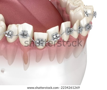 Abnormal teeth position and correction with metal braces tretament. Medically accurate dental 3D illustration