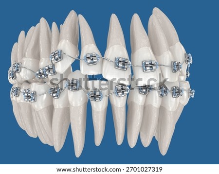 Abnormal teeth position correction with metal braces tretament. Dental 3D illustration