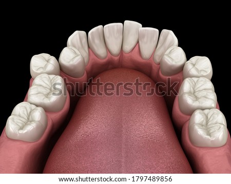 Abnormal teeth position, orthodontic concept. Medically accurate tooth 3D illustration