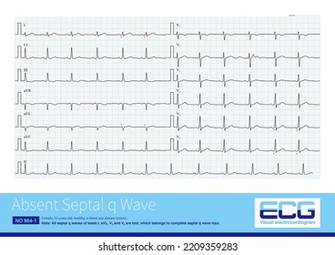 The Absent Septal Q Wave In ECG May Be A Normal Variant, And The Pathological Reasons Are Ventricular Septal Fibrosis, Intraventricular Block And Myocardial Disease.