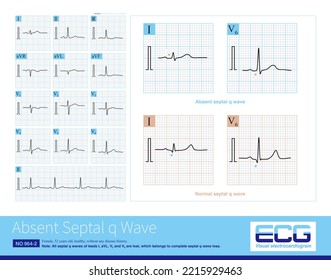 The Absent Septal Q Wave In ECG May Be A Normal Variant, And The Pathological Reasons Are Ventricular Septal Fibrosis, Intraventricular Block And Myocardial Disease.