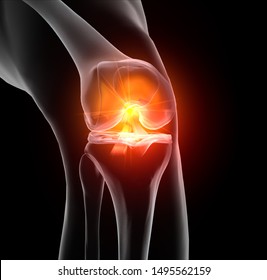 Accurate medically 3D illustration showing painful knee joint with highlighted anterior and posterior cruciate ligament, meniscus, articular cartilage, femur and tibea.