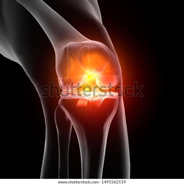 Accurate medically\
3D illustration showing painful knee joint with highlighted\
anterior and posterior cruciate ligament, meniscus, articular\
cartilage, femur and\
tibea.