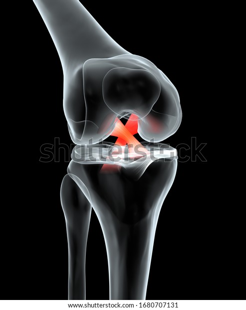 Accurate medically\
3D illustration showing painful knee joint with highlighted\
anterior and posterior cruciate ligament, meniscus, articular\
cartilage, femur and\
tibia.