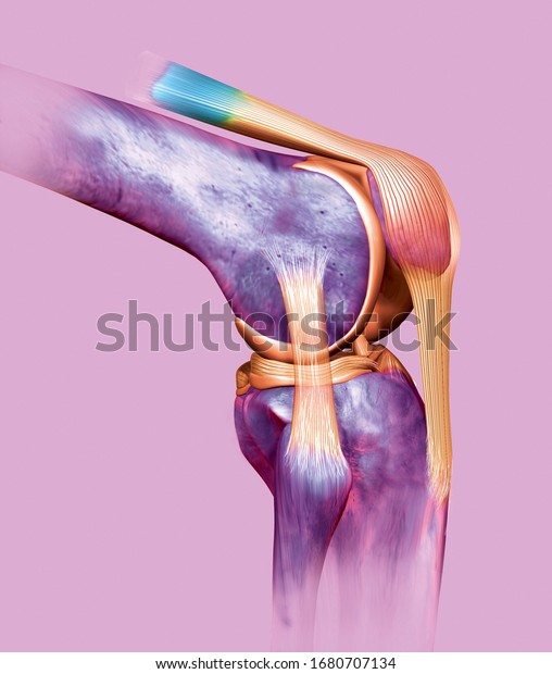 Accurate\
medically 3D illustration showing painful knee joint with\
highlighted anterior and posterior cruciate ligament, meniscus,\
articular cartilage, patella, femur and\
tibia.