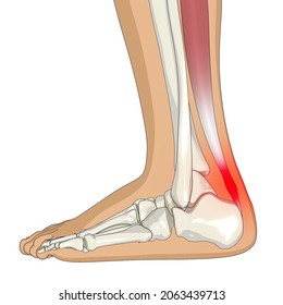 Achilles Tendinitis 3D Illustration, Foot Anatomy, Heel Pain, Foot Pain