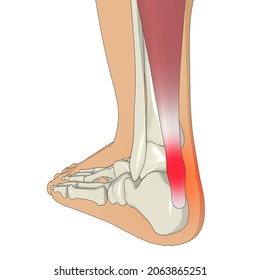 Achilles Tendinitis 3D Illustration, Foot Anatomy, Heel Pain, Foot Pain