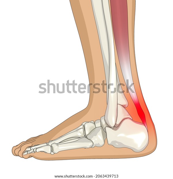 Achilles Tendinitis 3D Illustration, Foot Anatomy,\
Heel Pain, Foot\
Pain