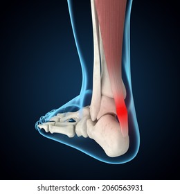 Achilles Tendinitis 3D Rendering, Foot Anatomy, Heel Pain, Foot Pain