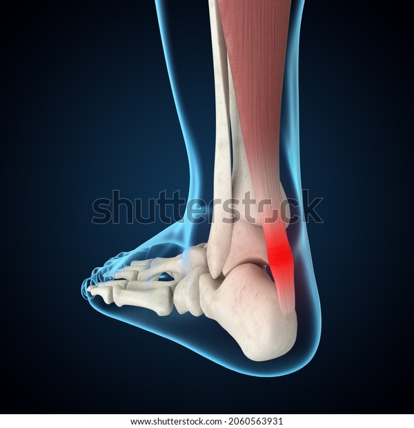 Achilles Tendinitis 3D Rendering, Foot Anatomy, Heel\
Pain, Foot Pain