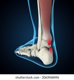 Achilles Tendon Rupture 3D Rendering, Foot Anatomy, Heel Pain, Foot Pain, Achilles Tendinitis