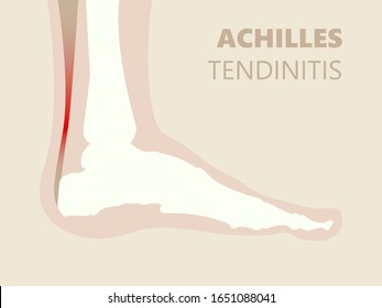 Achilles Tendonitis Tendinitis Tendinopathy Illustration Showing Overuse Injury Causing The Inflammation And Degeneration Of The Achilles Tendon Calf Muscles Sharp Pain At Back Near Heel Of Runners.