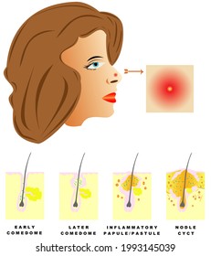 Acne Acne Divided Into Four Types Stock Illustration 1993145039 ...