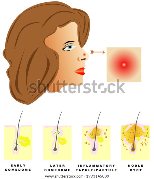 Acne. Acne is\
divided into four types: Comedones, Papules, Pustules, Nodules and\
cysts on white\
background.