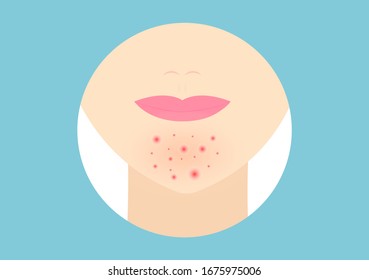 Acne On The Chin Of Women,Concept Of Beauty And Acne Treatment