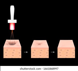 Acne Scars. Laser Scar Atrophic Treatment. The Anatomical Structure Of The Skin With Acne. Illustration.