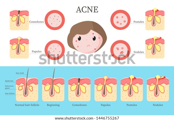 Acne Types Progression Stages Infographics Flat Stock Illustration ...