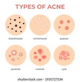 Acne Types. Skin Infection Problem, Pimples Grade And Type Cyst, Whitehead, Blackheads, Nodule And Cystic. Dermis Pore Disease  Set