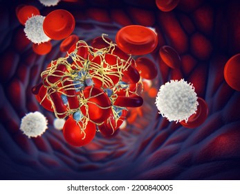 Activated Platelets (thrombocytes) Forming A Blood Clot (thrombus) Covered By Fibrin Mesh, 3d Illustration. The Platelets Are Blood Cells Responsible For Repairing Blood Vessel Damage