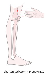 Active Acupuncture Points On The Legs:  Above The Knee. 