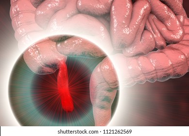 Acute Appendicitis, 3D Illustration Showing Inflammed Appendix On The Cecum