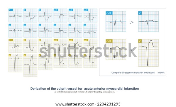 Acute Extensive Anterior Myocardial Infarction Culprit Stock ...