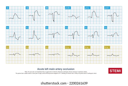 276 Left Circumflex Artery Images, Stock Photos & Vectors 