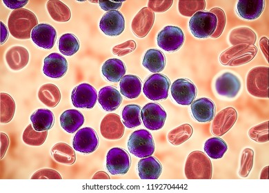 Acute Lymphoblastic Leukemia Bone Marrow Smear Stock Illustration ...