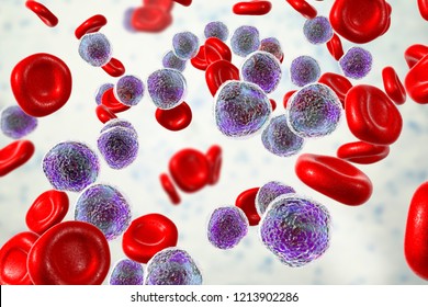 Acute Lymphoblastic Leukemia, Bone Marrow Smear, 3D Illustration