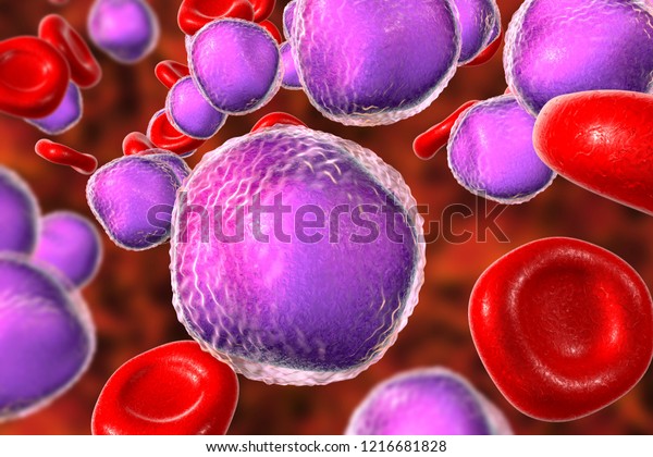 Acute Lymphoblastic Leukemia Bone Marrow Smear Stock Illustration ...