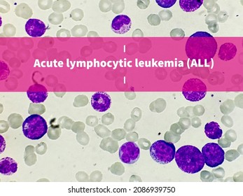 198 Neutrophilic promyelocyte Images, Stock Photos & Vectors | Shutterstock