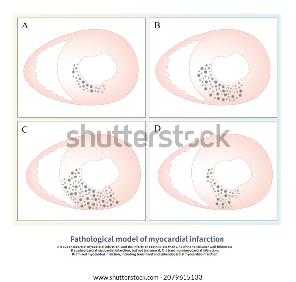 In acute myocardial\
infarction, different depth of ventricular wall infarction will\
produce different ECG patterns, such as ST segment depression and\
ST segment elevation.
