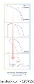 If Acute Myocardial Ischemia Affects The Epicardium, The Epicardial Action Potential Is Shortened, And The ST Segment Of The Electrocardiogram Is Elevated And The T Wave Is Towering.