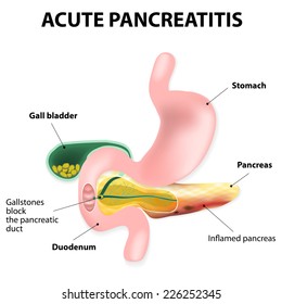 Acute Pancreatitis Inflammation Pancreas Gallstones Block Stock ...