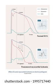 In Acute Transmural Myocardial Ischemia, Epicardial Action Potential Time Was Shortened And ST Segment Was Elevated.