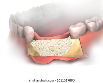 Adding New Bone To Bone Loss On Lower Jaw After Tooth Removal.  Bone Grafting Placement In Front View. Before Putting Membrane On Bone Graft. 3D Illustration. Dental Augmentation Surgery. 