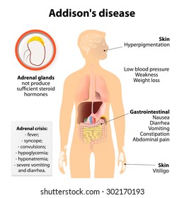 Addison's disease or Addison disease or chronic adrenal insufficiency or hypocortisolism and hypoadrenalism. Signs and symptoms.  Human silhouette with highlighted internal organs