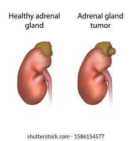 Adrenal Gland Tumor And Healthy Organ. Disease. Medical Anatomy Illustration.