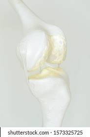 Advanced Osteoarthritis - Stage 3 - On The Knee Joint - High Degree Of Detail -- 3D Rendering