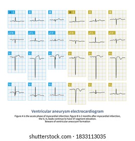 St elevation myocardial infarction Images, Stock Photos & Vectors ...