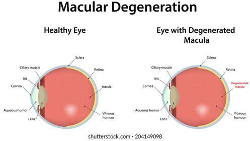 Age Related Macular Degeneration 