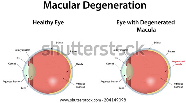 Age related macular degeneration что это