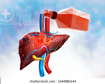 Alcohol With Liver. Alcoholic Liver Damage Concpet. 3d Illustration	