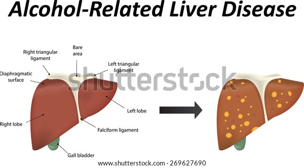 Alcohol Related Liver Disease Jpeg Stock Illustration 269627690